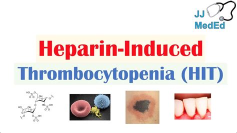 Heparin Induced Thrombocytopenia Hit Types Signs And Symptoms