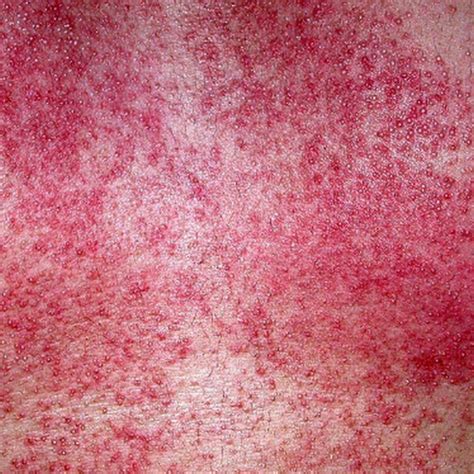 Miliaria Rubra Current Health Advice Health Blog Articles And Tips
