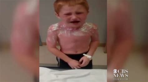 Graphic Images Oklahoma Boys Suffer Third Degree Sunburns At Daycare