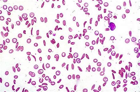 Sickle Cell Disease Pathophysiology Wikidoc