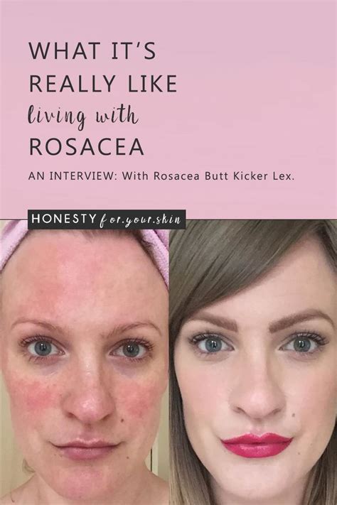 What Its Really Like Living With Rosacea Rosacea Skin Care Sensitive Skin Treatment Facial
