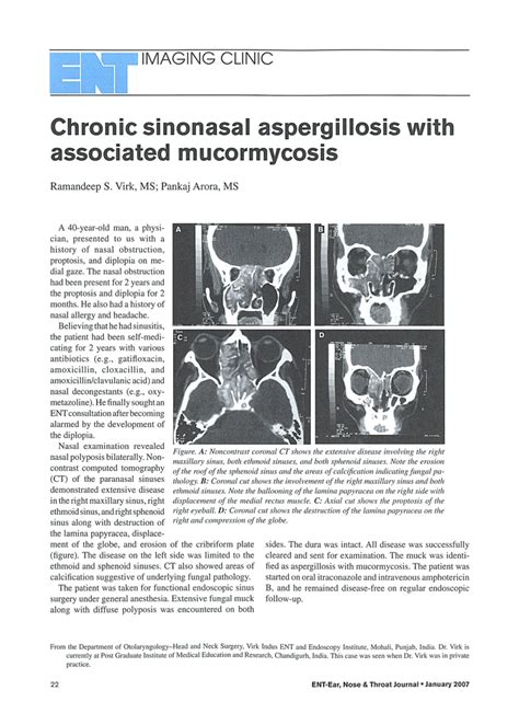 Pdf Chronic Sinonasal Aspergillosis With Associated Mucormycosis