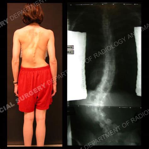 Scoliosis In Adults An Overview