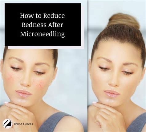 How To Reduce Redness After Microneedling Expert Tips