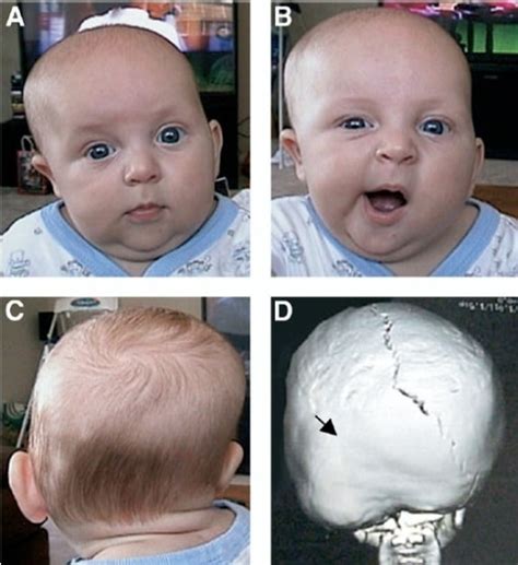 List 100 Pictures Abnormal Baby Head Shape Pictures Updated 102023