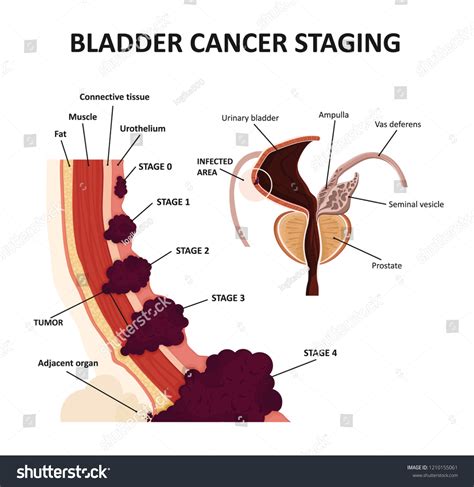 Stages Urinary Bladder Cancer Classification Malignant Stock Vektor Royaltyfri 1210155061