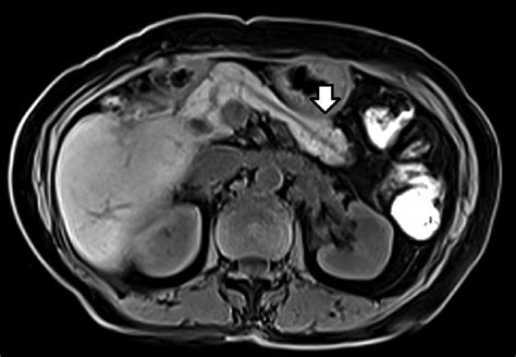 Axial T1 Weighted Fat Suppressed Image Showing Relatively Hyperintense