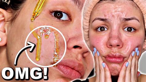 The Oil Cleansing Method On Oily Skin Oil Cleansing Before And After Audrey Victoria