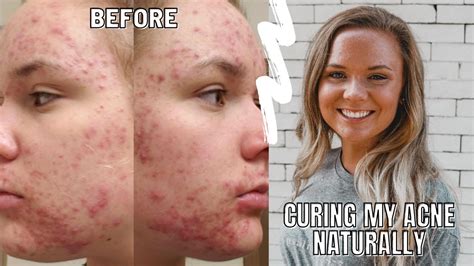 How I Healed My Cystichormonal Acne Naturally My Story No