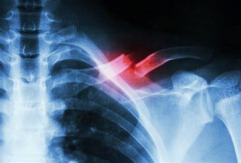 Broken Collarbone Clavicle Fracture Symptoms Complications