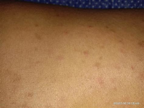Itching With Rash Back Side Of Body