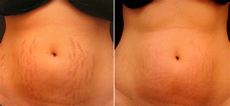 laser stretch mark removal the advanced way of removing stretch marks
