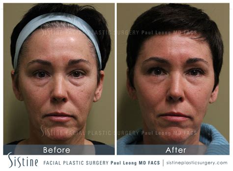 Scar Wrinkle Removal Before And After Sistine Facial Plastic Surgery