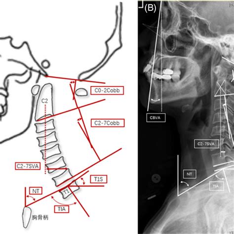Seven Cervical Sagittal Parameters A The Sketch Map B The