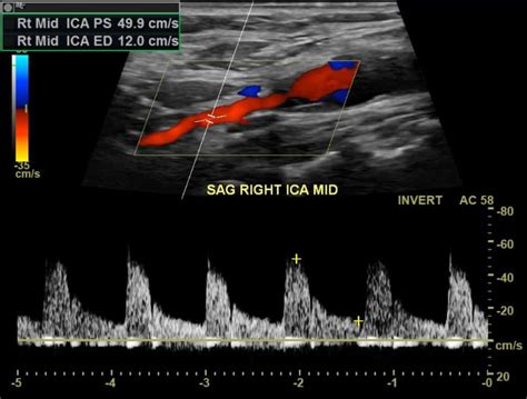 Carotid Artery Dissection Ultrasound Vascular Medicine Angiologist