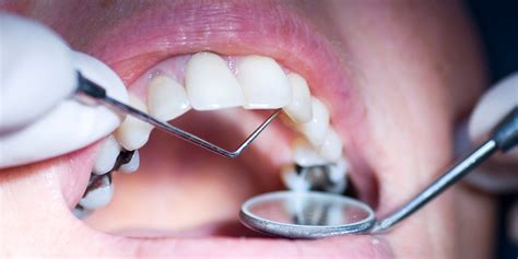 A cavity is a decayed spot or hole in a tooth caused by acids in the mouth. 5 Cavity Symptoms You Shouldn't Ignore | SELF