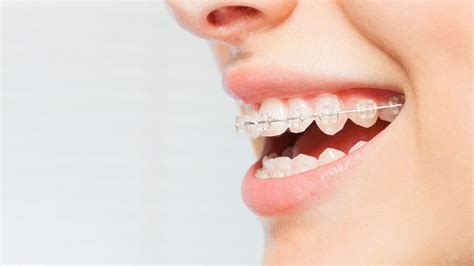 10 Best Ceramic Braces Clinics In Singapore 2022