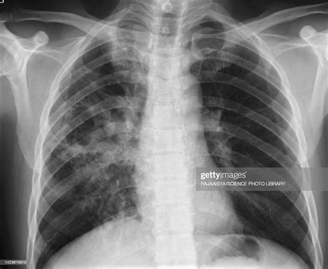 Lung Abscess Xray High Res Stock Photo Getty Images