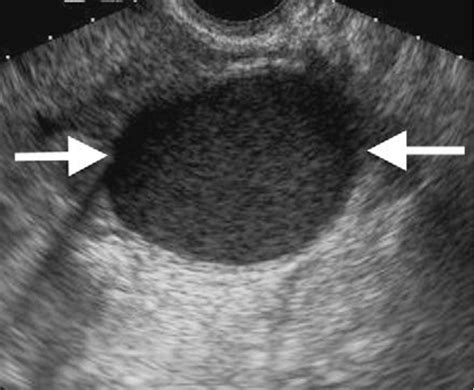 Transvaginal Ultrasound Scan Of A Complex Cystic Solid Ovarian Tumor In