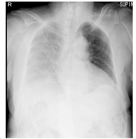Chest X Ray Findings On POD 1 We Confirmed A Right Pleural Effusion In