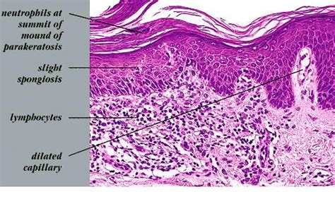 Guttate Psoriasis Histology