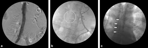 Figure 2 From Sequential Inferior Vena Cava Filter Insertion And