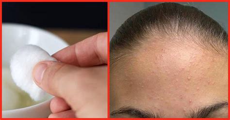 √ How To Get Rid Of Pimples On Forehead 4 Ways To Get Rid Of Forehead