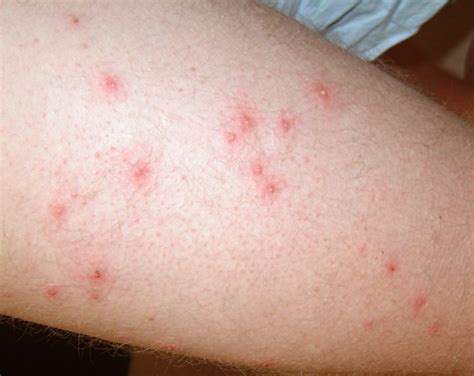 Itchy Red Bumps On Skin Common Causes With Treatment