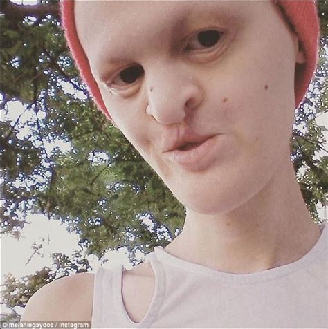 Melanie Gaydos Model With Ectodermal Dysplasia Storms Fashion Industry Daily Mail Online
