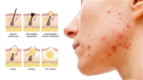 15 Science Proven Habits That Improve Acne Prone Skin