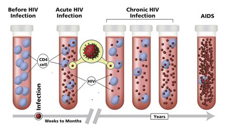 Infection With Hiv Helal Medical Sexually Transmitted Diseases Stds
