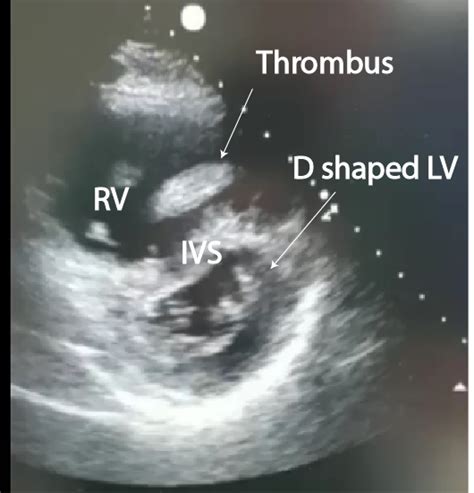 Pulmonary Embolism Right Ventricular Thrombus Critical Care Sonography