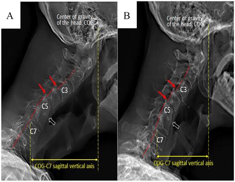 Isolated Neck Extensor Myopathy Associated With Cervical Spondylosis A