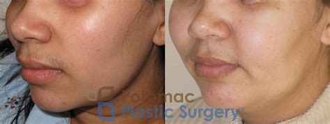 Cheek Augmentation With Silicone Implant And Fat Transfer To Balance