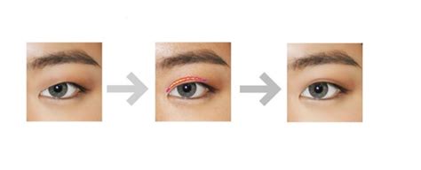 Asian Double Eyelid Cosmetic Surgery Stanford Medicine