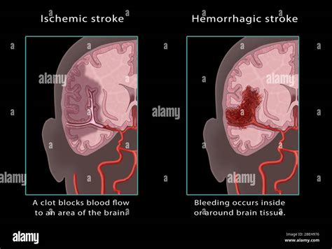 Ischemic And Hemorrhagic Stroke Kulturaupice