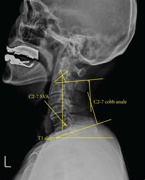 Illustration Of Cervical Sagittal Balance Radiographic Measurements