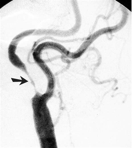 Carotid Artery Stenosis Stepwards