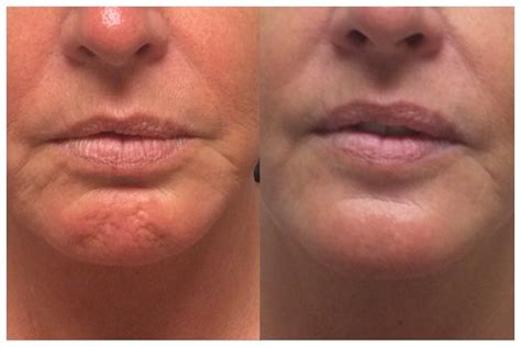 My Client Loves The New And Improved Appearance Of Her Chin Botox Is A