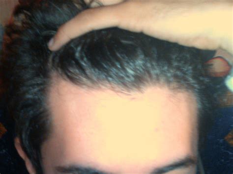 Hair loss of 24 year old male (india). Is My Hairline Normal for an 18 Year Old (With Photos ...