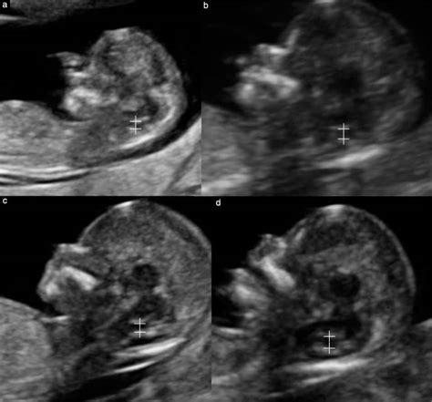Intracranial Translucency Calipers In Four Fetuses Scanned