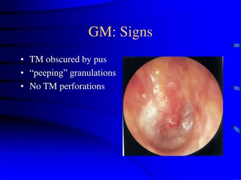 Ppt Infections Of The External Ear Powerpoint Presentation Free