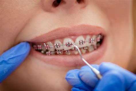 Understanding Orthodontic Braces Lancaster Orthodontist