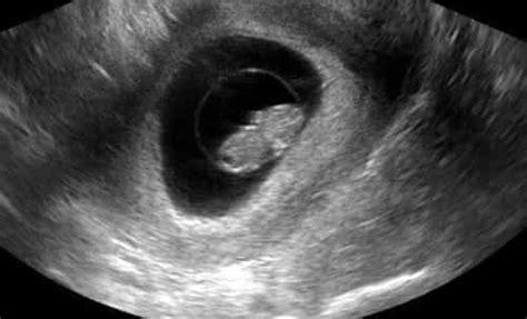 8 Week Pregnancy Ultrasound