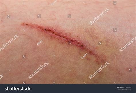 Wound On Human Body Suture Old Stock Photo 1072646648 Shutterstock