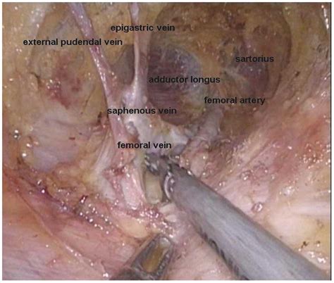 Preliminary Experience Of Performing A Video Endoscopic Inguinal