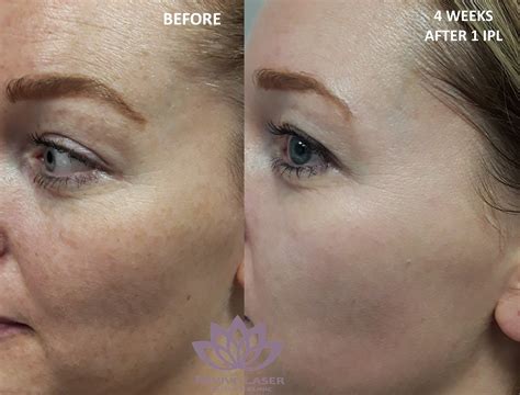 Ipl Before And After New Revive Laser And Skin Clinic
