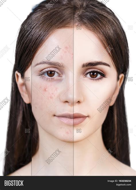 Woman Acne Before Image And Photo Free Trial Bigstock