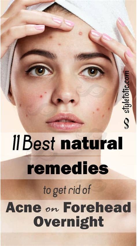 5 Best Acne Remedies To Get Rid Of Acne On Forehead Overnight