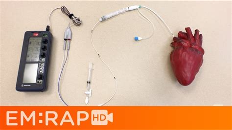 Sufficient Disclose Skirmish Transvenous Pacing Settings Passed Metric